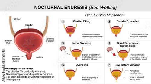 Nocturnal Enuresis - Bed-Wetting Medical Flashcard