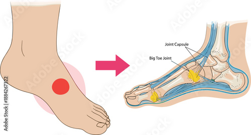 Foot pain anatomy, joint inflammation medical diagram, podiatry illustration, orthopedic condition, healthcare education visual, flat vector illustration