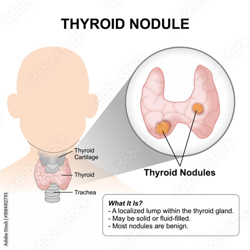 Thyroid Nodule, ENT Medical Flashcard