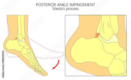 Posterior ankle impingement. Stieda process