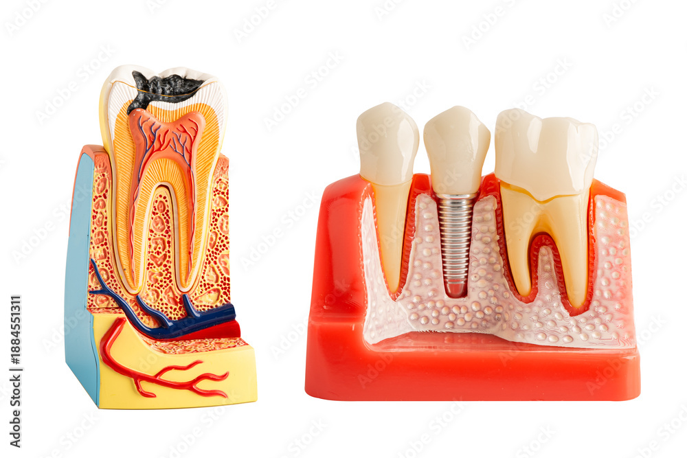 Obraz premium Dental implant, artificial tooth roots into jaw isolated on white background.