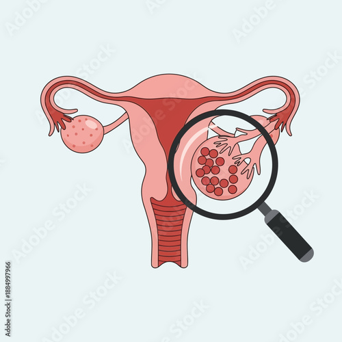 Uterus and ovaries with enlarged view of fibroid tumor under magnifying glass