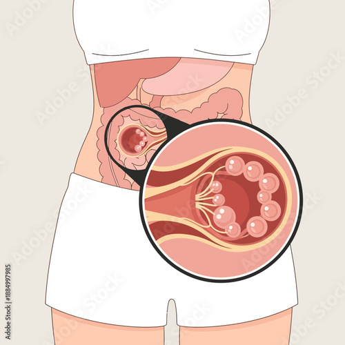 Human Colon Anatomy with Diverticula Magnified View Medical Illustration