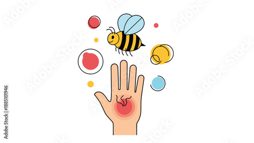 An illustration of a bee sting on a human hand, showing redness and swelling, symbolizing an allergic reaction or insect bite first aid.