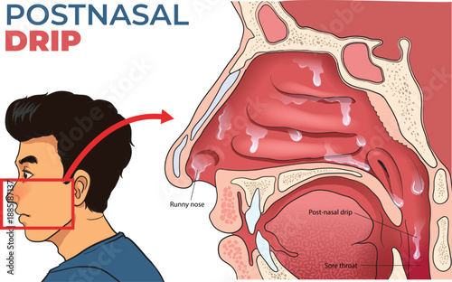 illustration of Postnasal Drip diagram