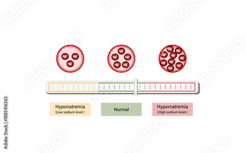 Hypernatremia, high plasma sodium level and Hyponatremia, low plasma sodium level. Sodium Na excess and deficit electrolyte disorders, blood test tube, Scientific design. Vector illustration.