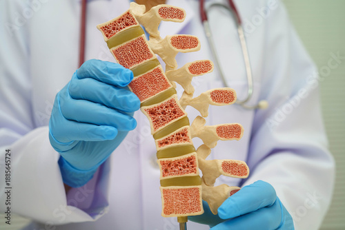 Doctor holding osteoporosis in back bone model for treatment medical in orthopedic department.