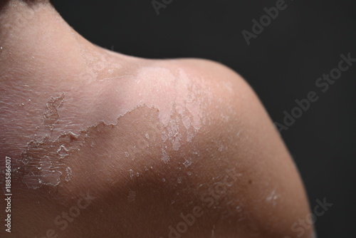 Tablou pe pânză Vitiligo skin disease in a child