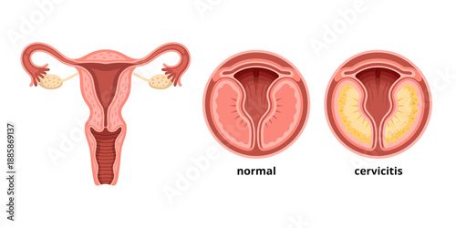 Illustration of Female Reproductive System with Cervicitis Comparison