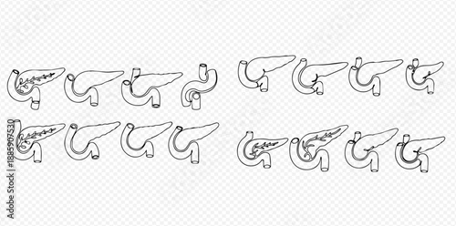 Set of human pancreas medical illustrations, showing different anatomical variations and conditions.
