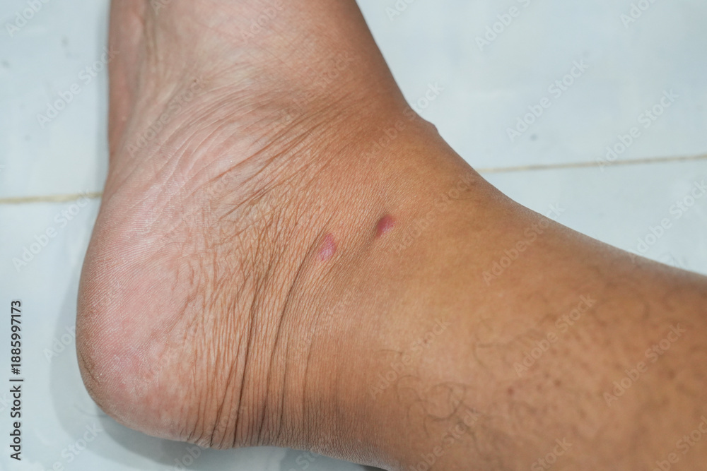 Naklejka premium Close-up of two small red spots or skin lesions on a person's ankle. Concept of dermatology, skin allergy, insect bites, or medical condition.