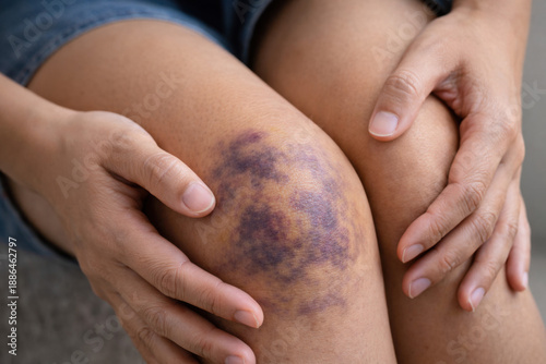 Close up of stain bruise wound on leg, contusion asian young woman, girl on joint knee from an accident fell down, hand in healing injury by massage hematoma blood. Extravasation blue, purple on skin.