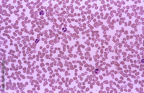 Blood smear. Neutrophil leukocytes
