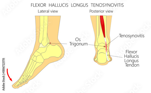 Flexor hallucis longus tenosynovitis. Posterior ankle impingement