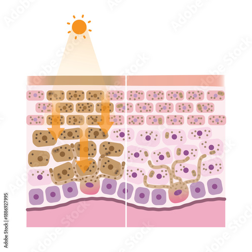 Comparison mechanism of hyperpigmentation and normal pigmentation illustration. Cross section of hyperpigmentation when the skin is exposed to UV rays, the melanin is overproduced causing melasma.