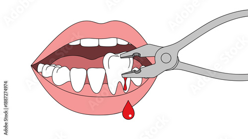 Illustration of dental extraction with blood from a patient's mouth -  