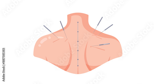 Acupuncture needles in a person's upper back and shoulders, vector illustration