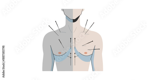Acupuncture needles on male torso vector illustration