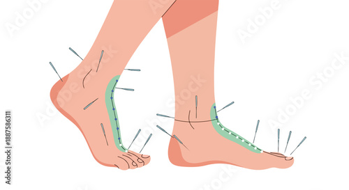 Acupuncture needles in human feet with highlighted pain points vector illustration
