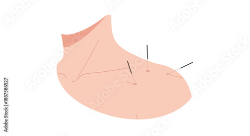 Acupuncture needles in human foot for pain relief and traditional Chinese medicine treatment