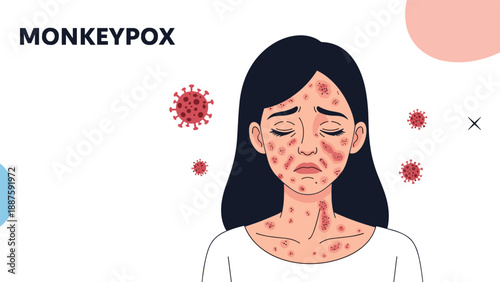 Monkeypox viral infection awareness illustration showing a woman with skin lesions and virus particles on a clean white background.