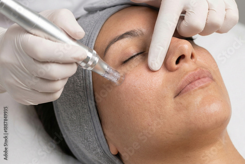 Professional Microneedling Facial Treatment with pen Device: Close-Up of Woman Receiving Skin Rejuvenation and Mesotherapy Procedure in Aesthetic Clinic