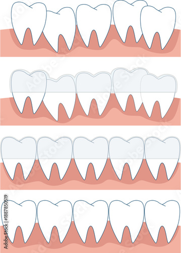 Vector Illustration of Dental Treatment and Oral Hygiene with Braces Applied to Crooked Teeth — Professional Stomatology Graphic for Medical and Educational Use. This artwork highlights orthodontic co
