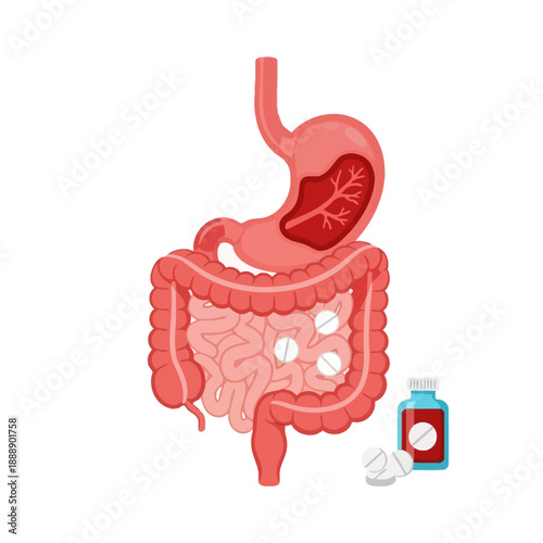 Human Digestive System Anatomy with Stomach Ulcer and Pills - Medical Illustration