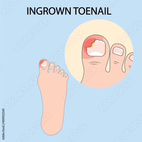 Vector illustration of ingrown toenail showing redness, swelling, pain, and infection, with related conditions such as paronychia, nail fungus, and toe inflammation.