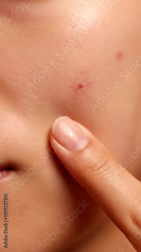 Wallpaper Mural Close-up of woman's face with acne, touching skin, skincare and beauty concept Torontodigital.ca