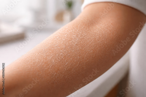 Dry skin dehydrated skin forearm closeup human arm flaky skin skin texture skin care dermatology health rough skin cracked skin skin surface epidermis sensitive skin irritation skin condition