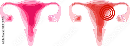 Uterus. Health and pain. Paper cut design element. Medical vector layered illustration.