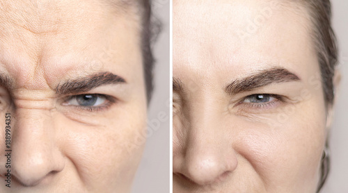Foto Collage photo Caucasian woman with wrinkles on the bridge of her nose and between the eyebrows and portrait after visiting a cosmetologist