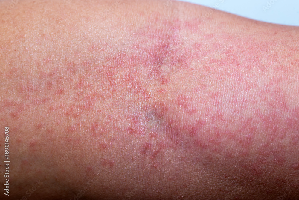 Fototapeta premium Close-up photo of a man’s arm with red itchy skin rash and inflammation caused by insect bite or chemical contact, showing allergic dermatitis, irritation, and skin reaction on human body.