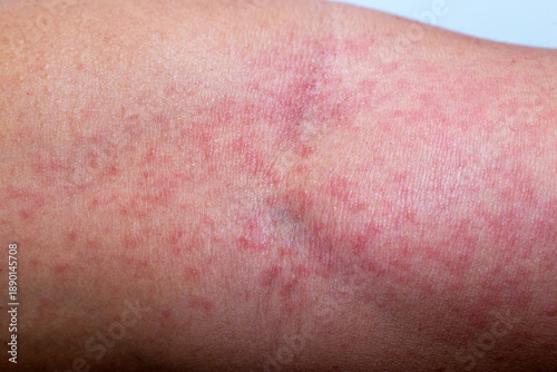 Wallpaper Mural Close-up photo of a man’s arm with red itchy skin rash and inflammation caused by insect bite or chemical contact, showing allergic dermatitis, irritation, and skin reaction on human body. Torontodigital.ca