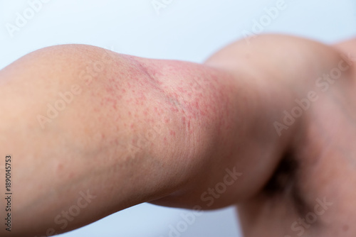 Wallpaper Mural Close-up photo of a man’s arm with red itchy skin rash and inflammation caused by insect bite or chemical contact, showing allergic dermatitis, irritation, and skin reaction on human body. Torontodigital.ca