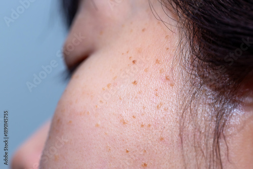 Wallpaper Mural Close-up in seborrheic keratosis, pore, acne and wrinkles in face woman uneven skin. Facial care skin problems for beauty and cosmetic background concept.	 Torontodigital.ca