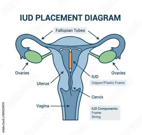 IUD placement diagram showing female reproductive system anatomy