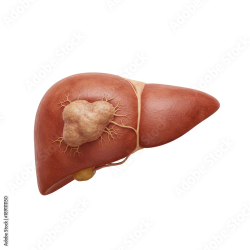 Medical Illustration Showing Malignant Tumor Growth on a Human Liver