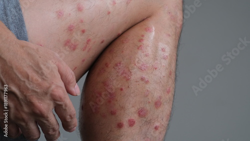 The early signs of redness on the skin that then dries and flare up to become Psoriasis Guttate on leg.