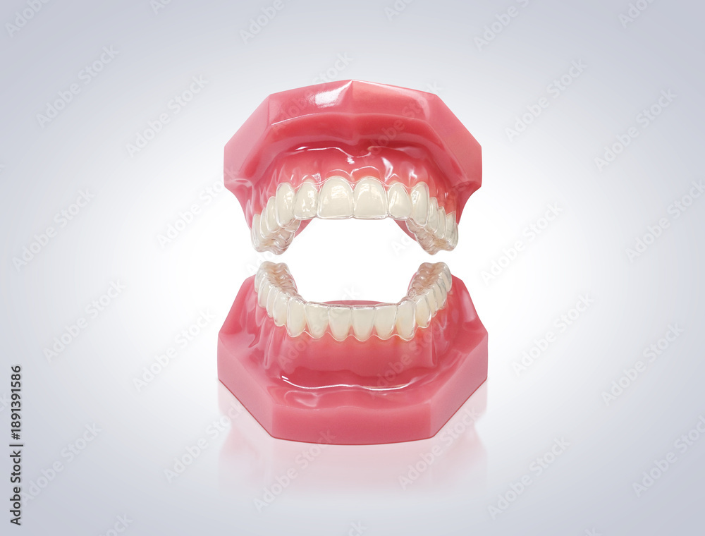 Obraz premium インビザライン マウスピース矯正 イラスト リアル