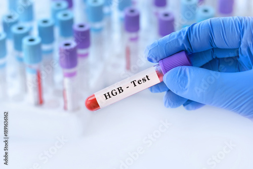 Photos A doctor holding a blood sample tube for a hemoglobin (HGB) test