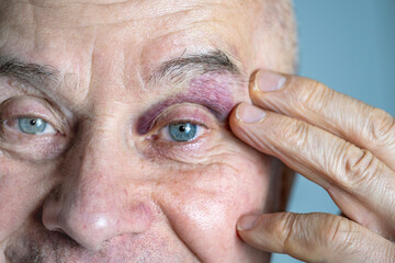 Eye senior man showing signs bruising, redness and hemorrhage. Medical condition, injury, hematoma, and healing process, blood vessel, violence and accident