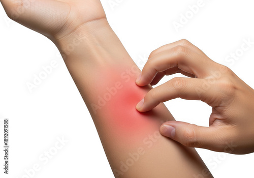 Closeup of a person scratching an itchy, red, inflamed rash or allergic reaction on their forearm, isolated on transparent background