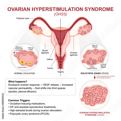 Ovarian Hyperstimulation Syndrome (OHSS) Flashcard
