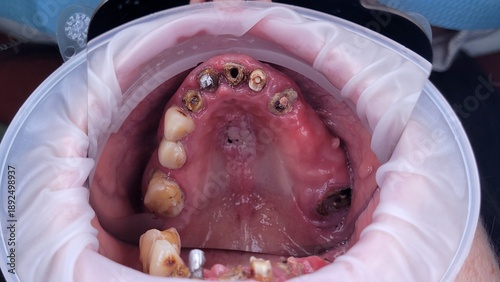Close-up of a patient’s open mouth during a dental procedure. Dentist preparing the oral cavity for dental implant placement. Medical instruments and professional dental treatment in a modern dental c
