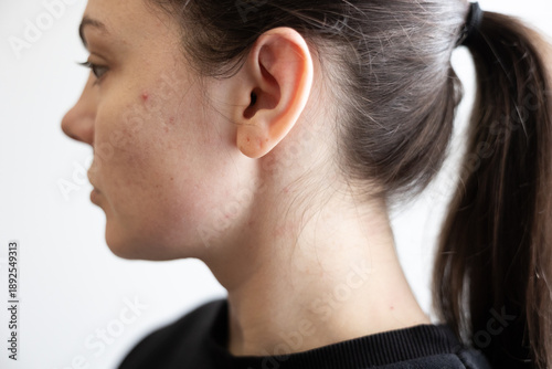 Принти на полотні Side profile portrait of a young woman with acne on her face
