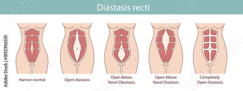 Different types of diastasis. Medical anatomical illustration.