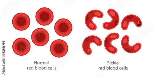 Comparison of Normal and Sickle Red Blood Cells Illustration