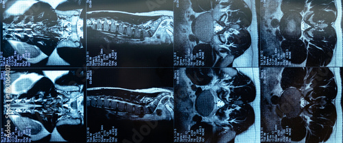 Fotografía Detailed mri scan reveals spinal protrusion and vertebrae structure